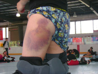 Bruise